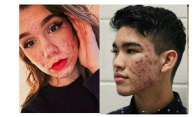Padrão com acne